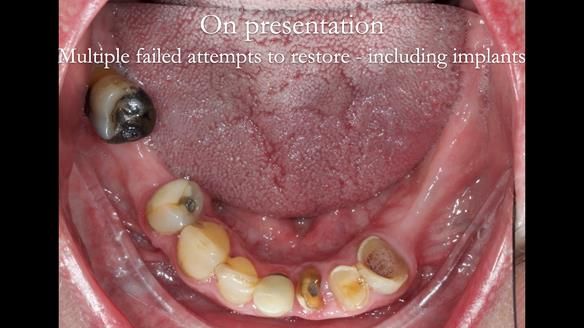 Newsletter 55 Provision of metal based partial dentures for Zephyrine with a repaired cleft lip and palate