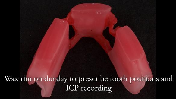 Finlay's Case Study Newsletter 40 - Immediate Mk 1 RPD to Definitive Mk 2 RPD - full protocol