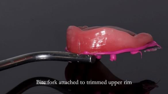 Newsletter 83: Sheila’s Complete Denture Success