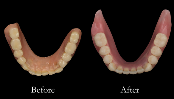 Figure 28 Before and after changes in shape of the denture fitting surfaces. Optimal extensions from border moulding. New denture metal reinforced too