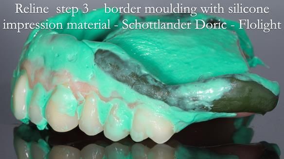 Newsletter 54 case presentation upper complete denture and lower Scandinavian designed hygienic partial denture for David