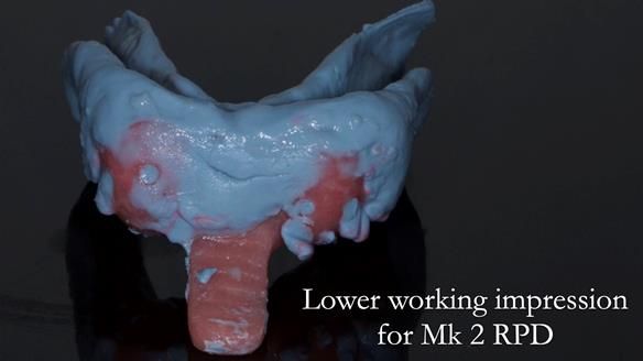 Finlay's Case Study Newsletter 40 - Immediate Mk 1 RPD to Definitive Mk 2 RPD - full protocol