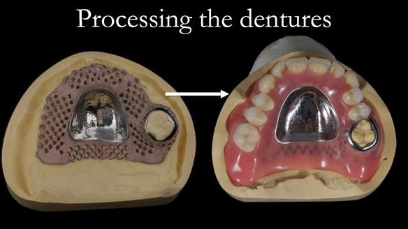 Finlay's Newsletter 58 Gasket upper partial denture for Zoe