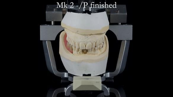 Newsletter 54 case presentation upper complete denture and lower Scandinavian designed hygienic partial denture for David