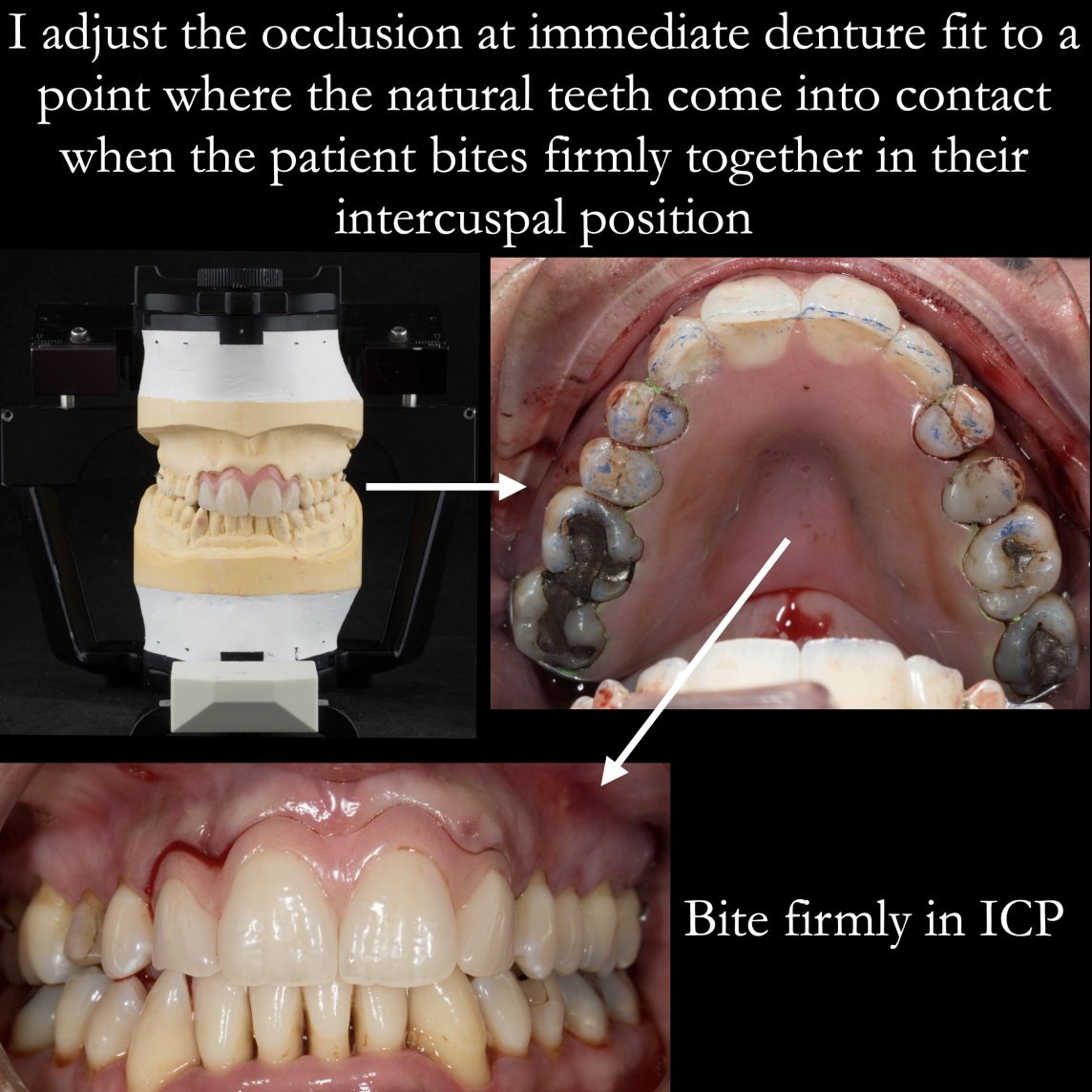 Method for adjusting the occlusion on immediate partial dentures – at the extraction visit