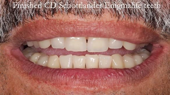 Finlay's Newsletter 62 provision of extractions and metal based complete dentures for Rafique