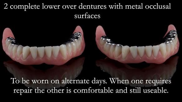 Newsletter 44 - extreme removable prosthodontics – engineering a super-strong and ultra-thin over denture