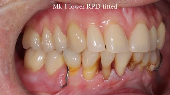 Newsletter 54 case presentation upper complete denture and lower Scandinavian designed hygienic partial denture for David