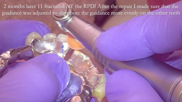 Read Newsletter 67 - Brian's COMBAT DENTURE Case Study