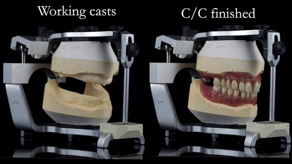 Newsletter 53 showing the making and fitting of ultra life-like dentures for Valena