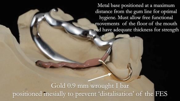 Finlay's Newsletter 61 provision of a lower unilateral free end saddle metal based partial denture for Joyce