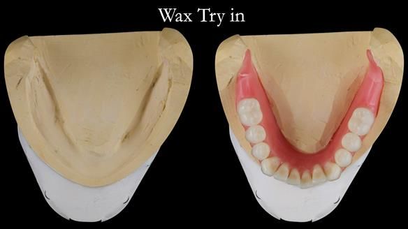 Replacing Madeline’s Complete denture FULL PROTOCOL