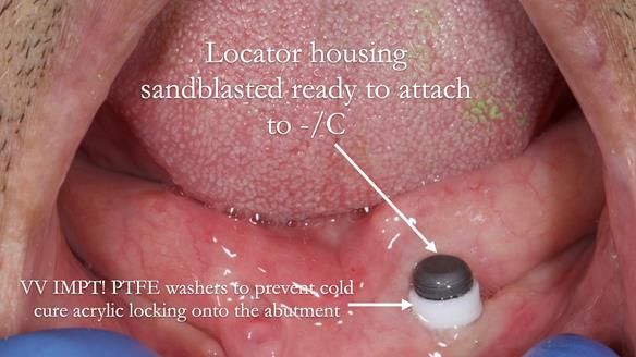 Managing poor implant positioning with complete dentures and Locator attachments - full protocol Newsletter 41