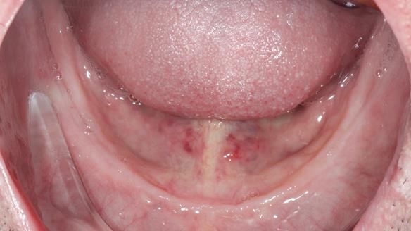 Newsletter 80 - Gordon’s dentures: the one case in 1,000 where my technique failed