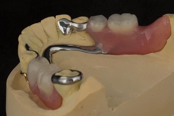 Figure 81 Finished definitive partial denture. Scandinavian design with sublingual bar - keeping the denture components 3mm away from the gingival margin