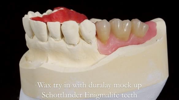 Finlay's Newsletter 64 case study - provision of a Kennedy class 2 metal based Scandinavian RPD for Ian