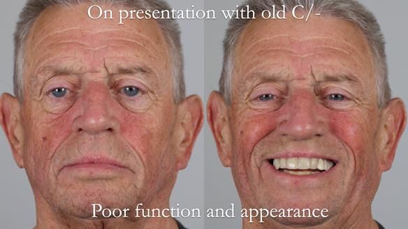 Newsletter 54 case presentation upper complete denture and lower Scandinavian designed hygienic partial denture for David