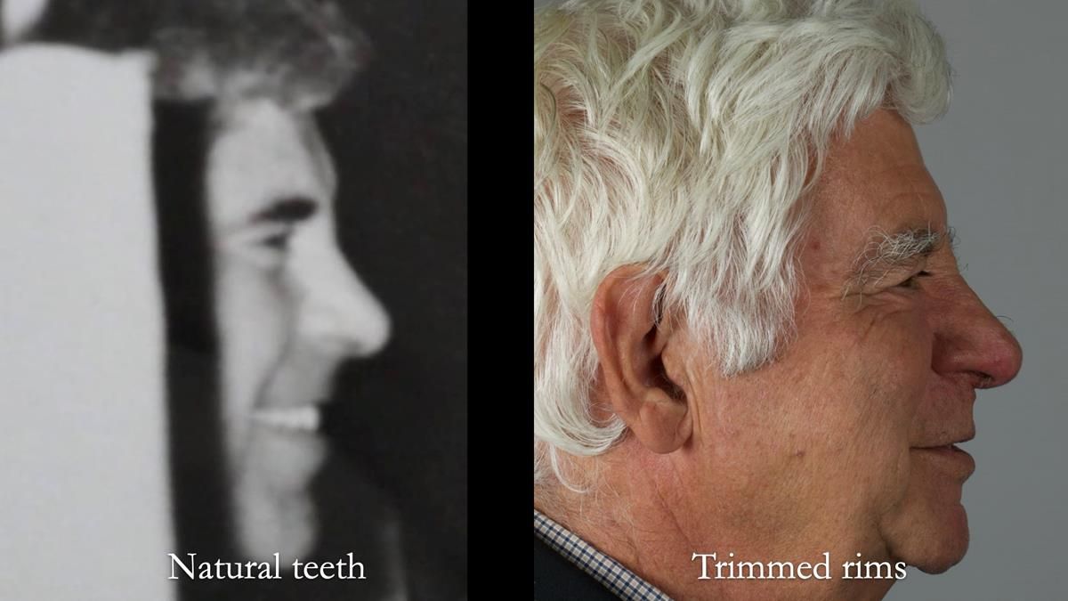 Fin’s Newsletter 88 — Complete dentures - full protocol… he rearranged his own teeth!