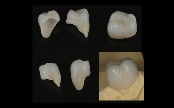 Figure 49 Porcelain fused to zirconia crown crowns mimicking Schottlander Enigmalife teeth in colour. Incorporating guiding surfaces, ledges and rest seats for the metal based partial dentures.