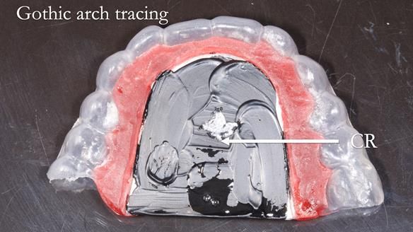 Newsletter 82 Mary - A complete upper and a one-tooth gasket denture