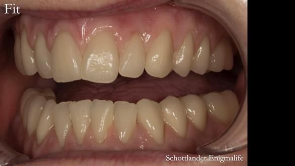 Newsletter 75: Marion’s case - Step-by-step complete denture workflow