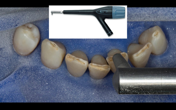 Figure 65 Sandblasting the lingual of the lower anterior teeth prior to provision of composite rest seats to assist in stabilising and supporting the metal based lower denture