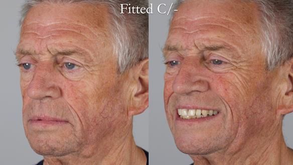 Newsletter 54 case presentation upper complete denture and lower Scandinavian designed hygienic partial denture for David