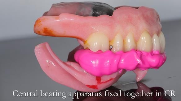 Newsletter 54 case presentation upper complete denture and lower Scandinavian designed hygienic partial denture for David
