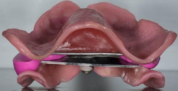 Figure 94 Visit 3 for Mk 2 fabrication. Inter-maxillary registration with central bearing apparatus with the maxillary and mandibular parts registered together with futar D bite registration material enabling mounting of maxillary and mandibular definitiv