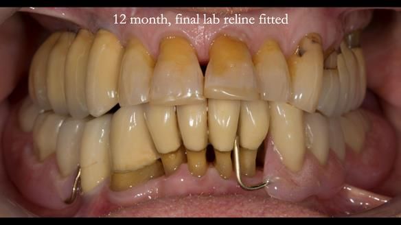 Ken – going downhill, first class