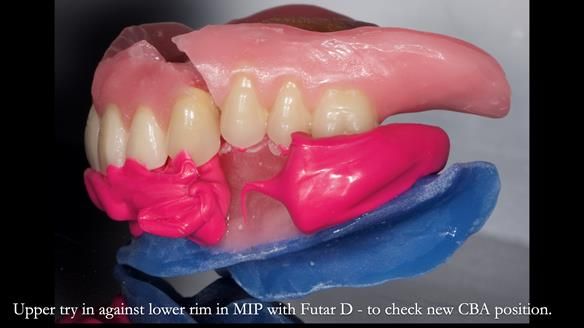 Newsletter 80 - Gordon’s dentures: the one case in 1,000 where my technique failed