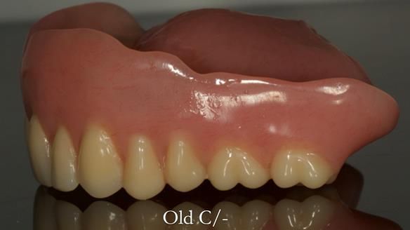 Complete denture Class II div 2 deep overbite Newsletter 39