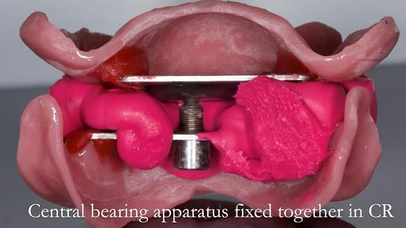 Complete denture Class II div 2 deep overbite Newsletter 39