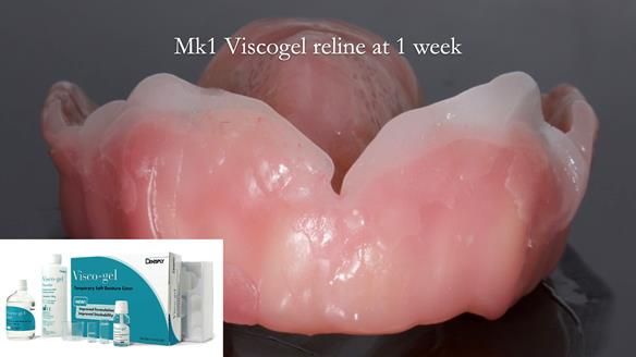 Newsletter 77: Jeremy’s case – immediate complete upper denture