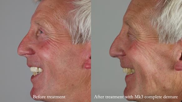 Newsletter 77: Jeremy’s case – immediate complete upper denture