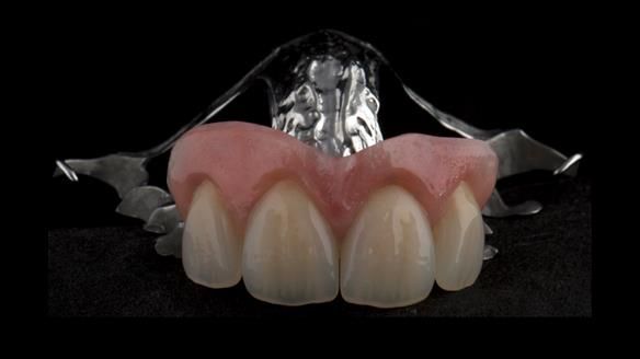 Finlay's Newsletter 63 Case study provision of metal based Scandinavian RPD - functional 10 years on