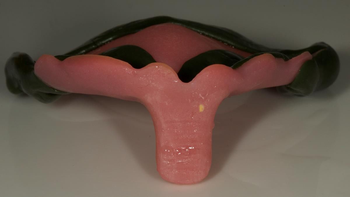 Newsletter 87 – Father Peter: A Partial Denture that needed Minor Miracle