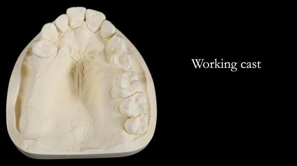 Finlay's Newsletter 64 case study - provision of a Kennedy class 2 metal based Scandinavian RPD for Ian