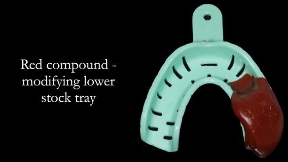 Newsletter 55 Provision of metal based partial dentures for Zephyrine with a repaired cleft lip and palate