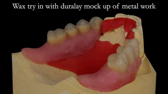 Finlay's Case Study Newsletter 40 - Immediate Mk 1 RPD to Definitive Mk 2 RPD - full protocol