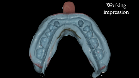 Figure 63 Working impression upper in custom tray with greenstick and alginate