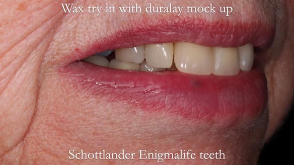 Finlay's Newsletter 59 Ultra hard partial dentures made for Gill