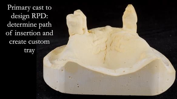 Finlay's Newsletter 59 Ultra hard partial dentures made for Gill