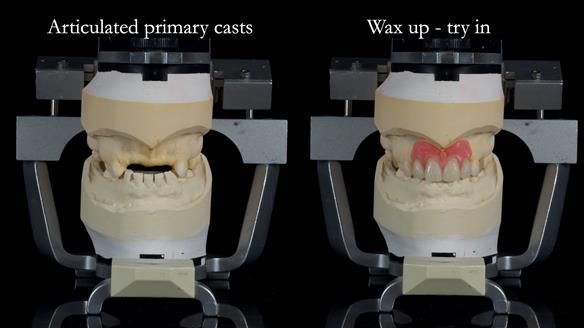Newsletter 81 - Pam’s Story — how a partial denture changed her life (+ live walkthrough this Thursday)