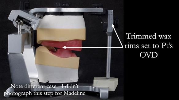 Replacing Madeline’s Complete denture FULL PROTOCOL
