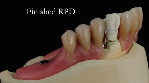 Finlay's Newsletter 59 Ultra hard partial dentures made for Gill