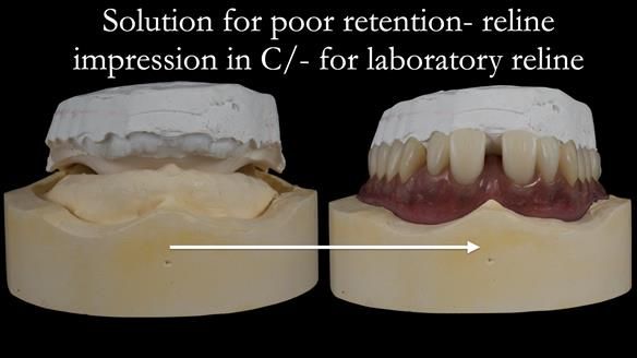 Newsletter 53 showing the making and fitting of ultra life-like dentures for Valena
