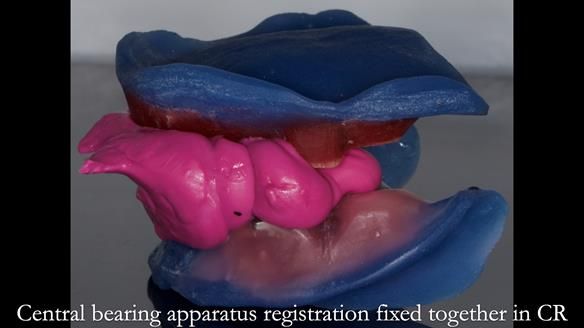 Newsletter 83: Sheila’s Complete Denture Success