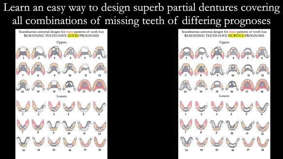 Newsletter 55 Provision of metal based partial dentures for Zephyrine with a repaired cleft lip and palate