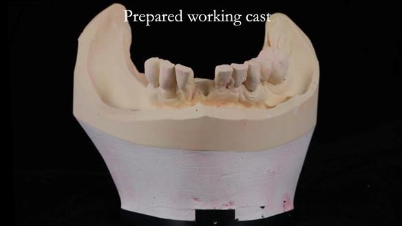 Newsletter 54 case presentation upper complete denture and lower Scandinavian designed hygienic partial denture for David